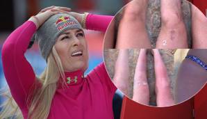 Lindsey Vonn zeigte die Narben ihrer Teamkolleginnen her